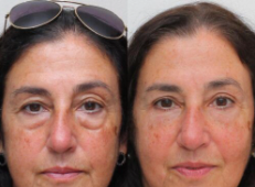 Before and after